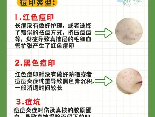 去痘印最好最快的方法：全面解析与实用指南