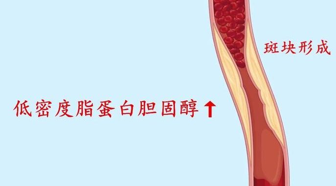 低密度脂蛋白胆固醇：健康隐患与科学管理