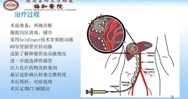 tace医疗：精准介入疗法在肿瘤治疗中的应用与优势